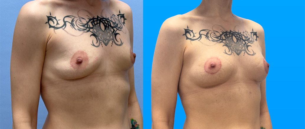 breast explant with fat transfer