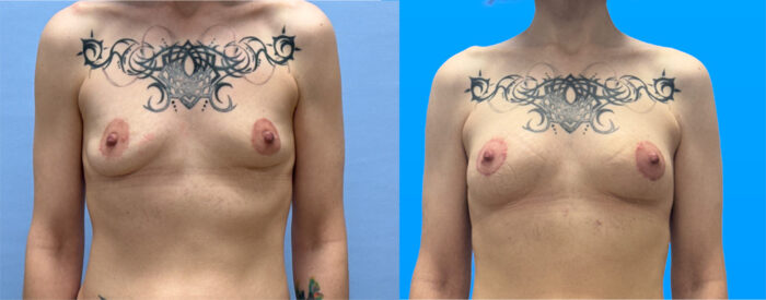 breast explant with fat transfer