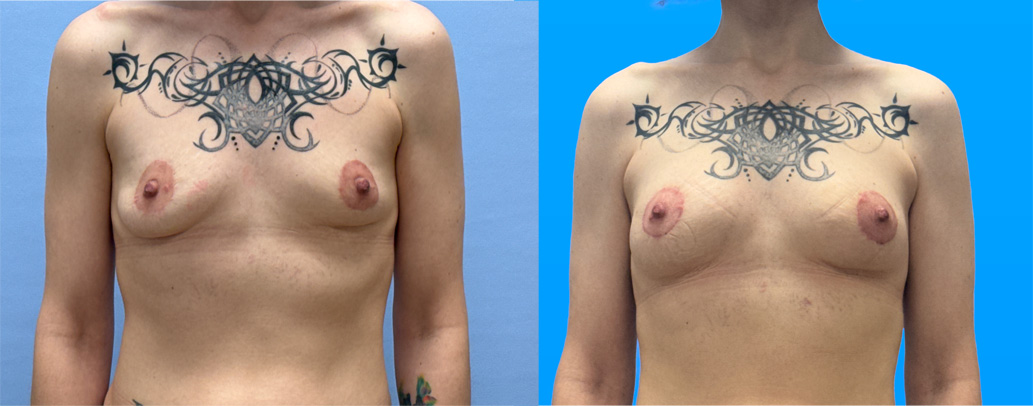 breast explant with fat transfer