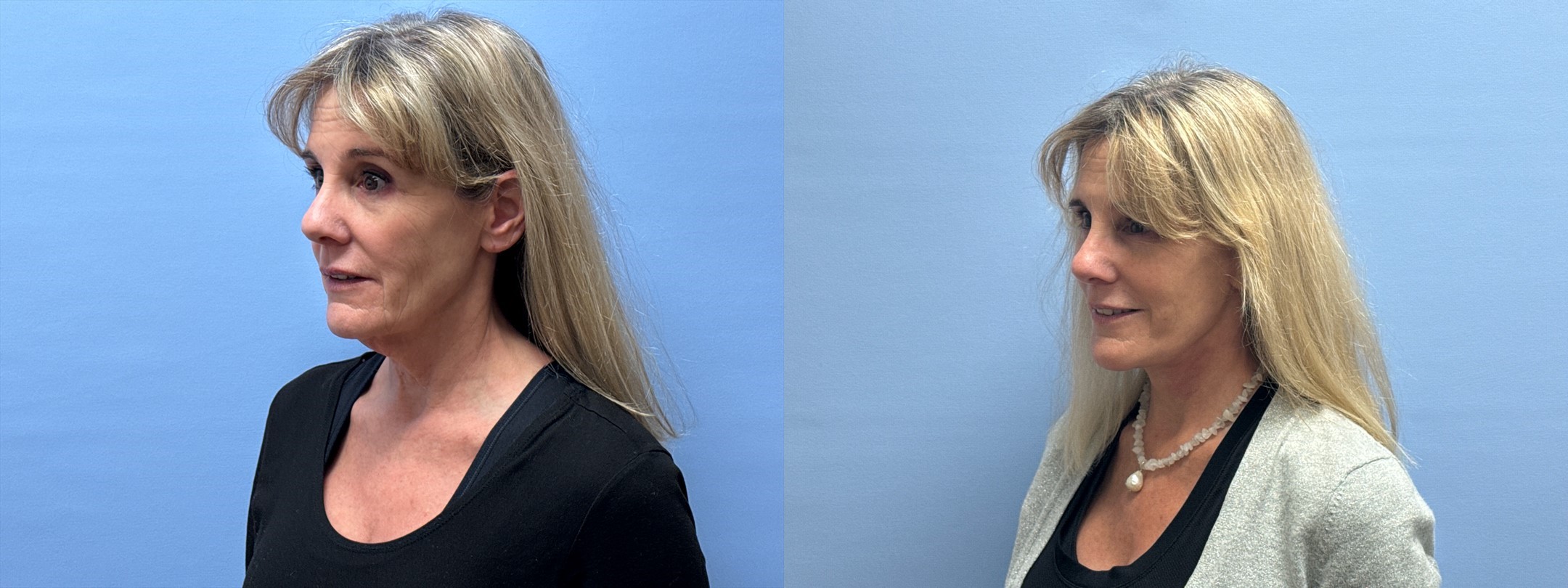Before and after photos of 59-year-old patient, 4 months post lower face/neck lift and brow lift by double board-certified plastic surgeon Dr. Shaun Parson in Scottsdale