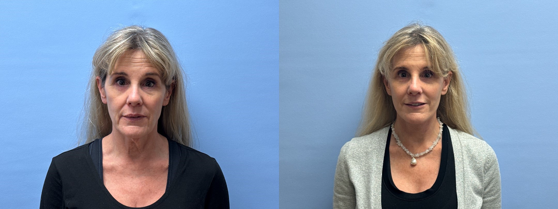 Before and after photos of 59-year-old patient, 4 months post lower face/neck lift and brow lift by double board-certified plastic surgeon Dr. Shaun Parson in Scottsdale