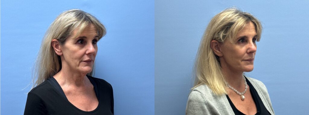 scottsdale semaglutide weight loss doctor GLP-1 for Medical in Phoenix AZ Dr. Shaun Parson Plastic Surgery