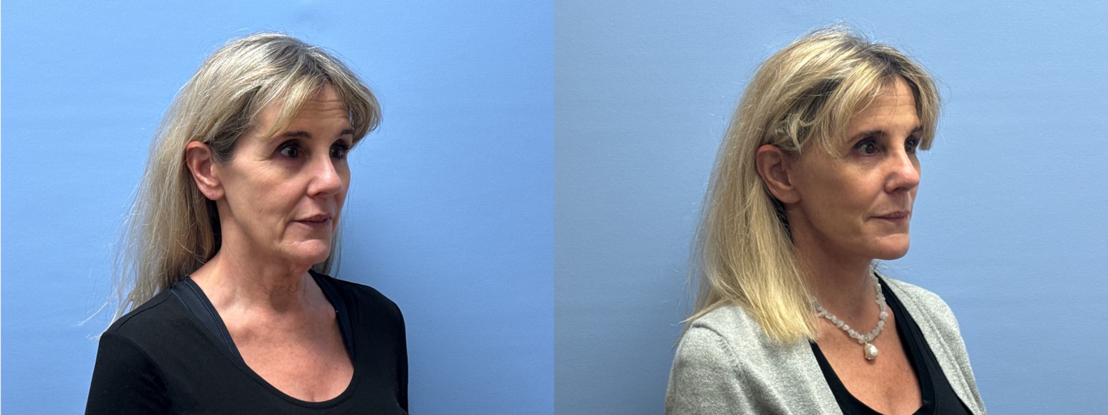 Before and after photos of 59-year-old patient, 4 months post lower face/neck lift and brow lift by double board-certified plastic surgeon Dr. Shaun Parson in Scottsdale