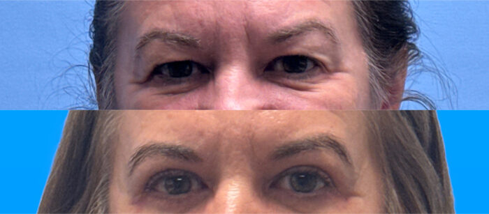 Post-op eyelid surgery photo, smoother lower lids and lifted upper lids, natural result