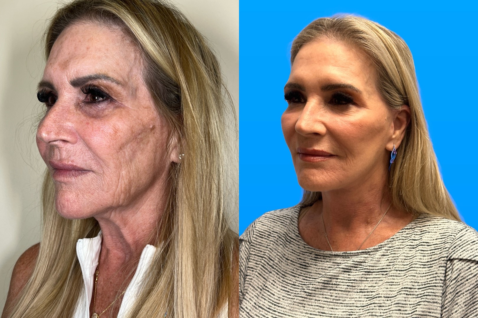 Scottsdale Facelift Patient with Helix Treatment