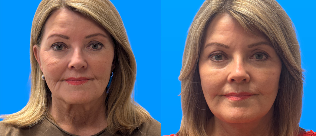 face and neck lift with upper eyelid | Scottsdale
