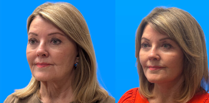 Necklift with Upper Blepharoplasty | Scottsdale