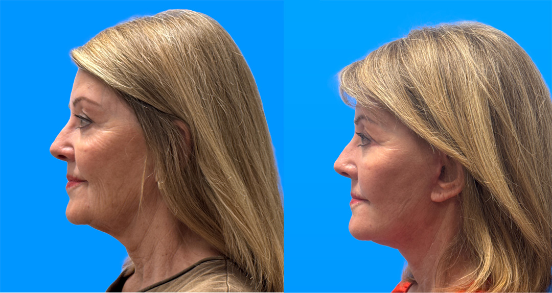 Necklift with Upper Blepharoplasty | Scottsdale