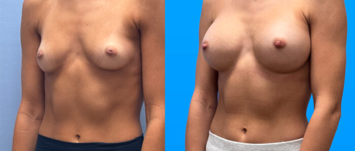 21-year-old patient prior to breast augmentation, side profile.