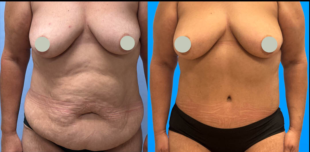 1 year post-op tummy tuck with flank liposuction results in Scottsdale