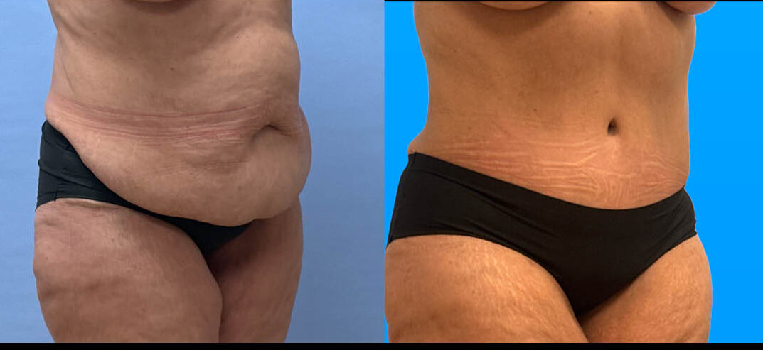 1 year post-op tummy tuck with flank liposuction results in Scottsdale