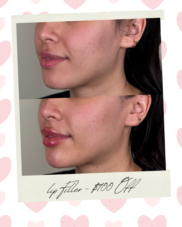 Lip Filler | Scottsdale Lip Filler | Scottsdale