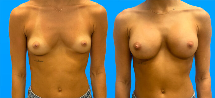 Breast Augmentation Scottsdale | Dr. Shaun Parson