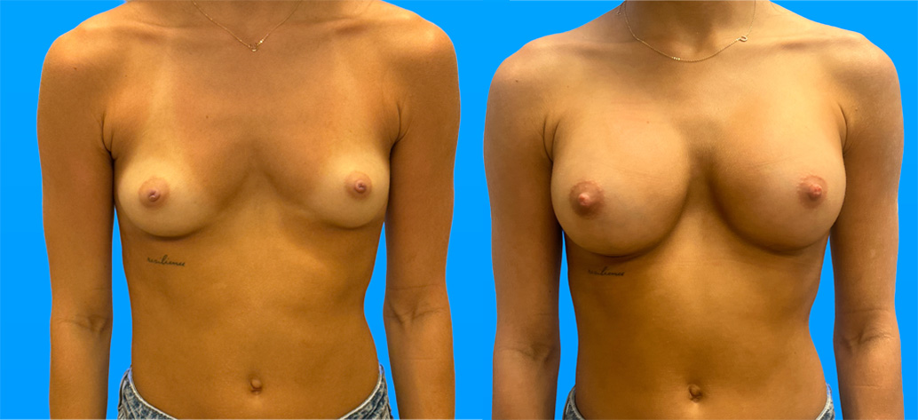 Breast Augmentation Scottsdale | Dr. Shaun Parson