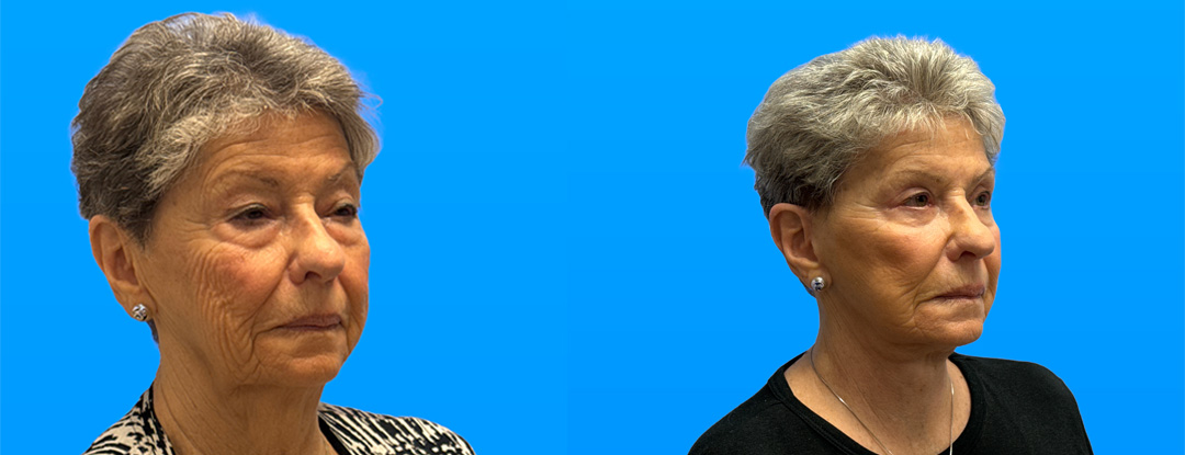 Before and after quad blepharoplasty and facelift in 82-year-old woman showing lifted jawline and brighter eyes in Scottsdale.