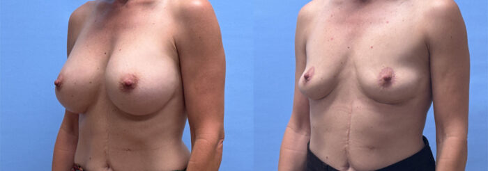 Breast Explant Patient | Scottsdale, AZ
