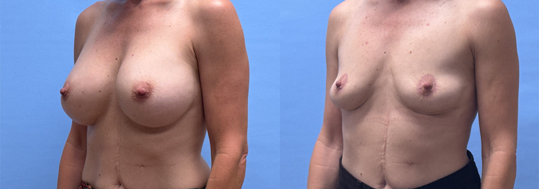 Breast Explant Patient | Scottsdale, AZ
