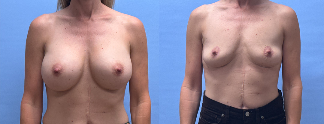 Breast Explant Patient | Scottsdale, AZ