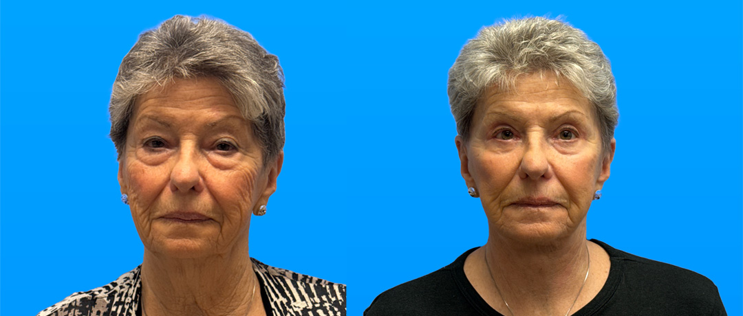Before and after quad blepharoplasty and facelift in 82-year-old woman showing lifted jawline and brighter eyes in Scottsdale.