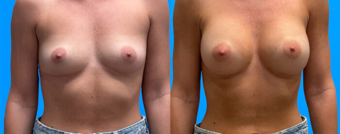Breast Augmentation Scottsdale AZ | 360cc Allergan Implants Before & After