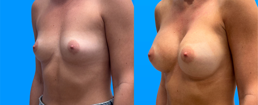 Breast Augmentation Scottsdale AZ | 360cc Allergan Implants Before & After