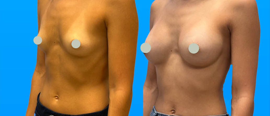 Natural breast augmentation results with moderate implant size