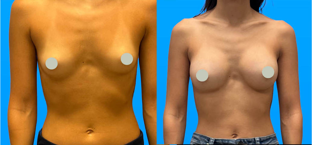 Natural breast augmentation results with moderate implant size