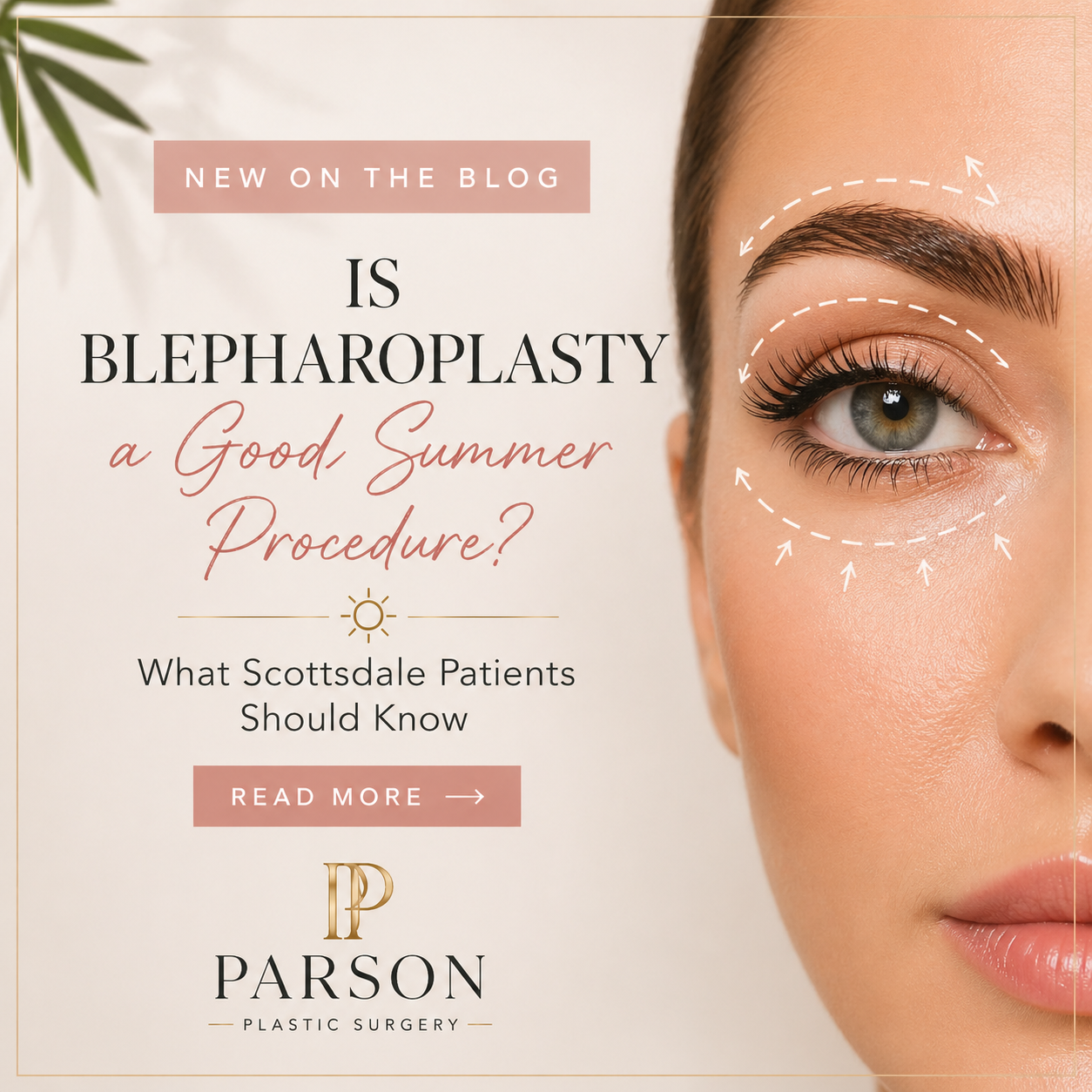 Before and after eyelid surgery showing refreshed eyes by Scottsdale plastic surgeon