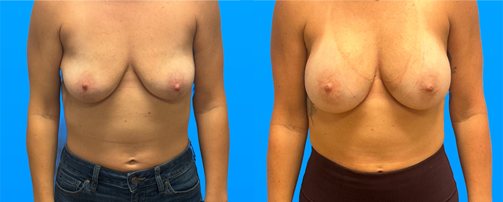 37-year-old breast augmentation before and after with 405cc Allergan implants using subfascial inframammary technique by Dr. Shaun Parson in Scottsdale AZ
