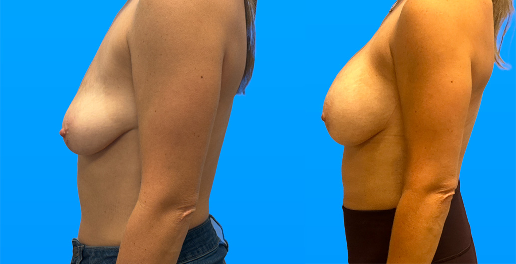 37-year-old breast augmentation before and after with 405cc Allergan implants using subfascial inframammary technique by Dr. Shaun Parson in Scottsdale AZ