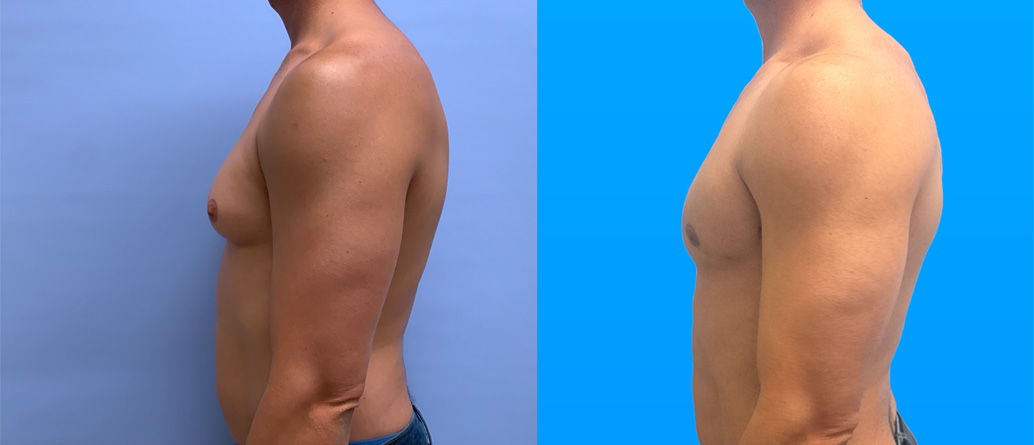 Gynecomastia surgery results 6 months post-op showing improved male chest contour Scottsdale AZ