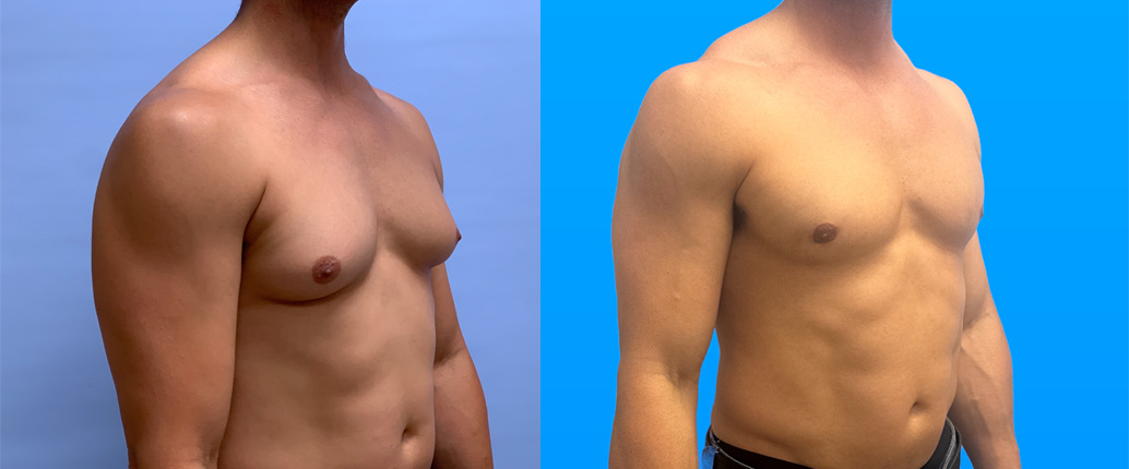 Gynecomastia surgery results 6 months post-op showing improved male chest contour Scottsdale AZ
