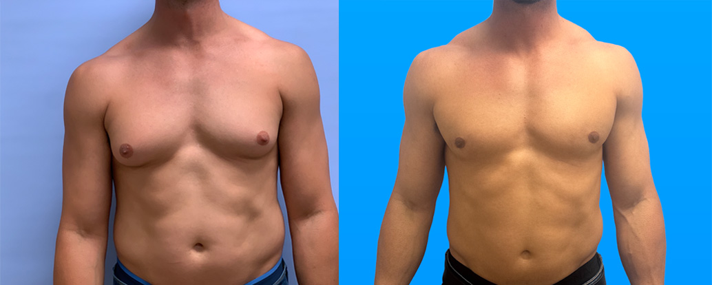 Gynecomastia surgery results 6 months post-op showing improved male chest contour Scottsdale AZ