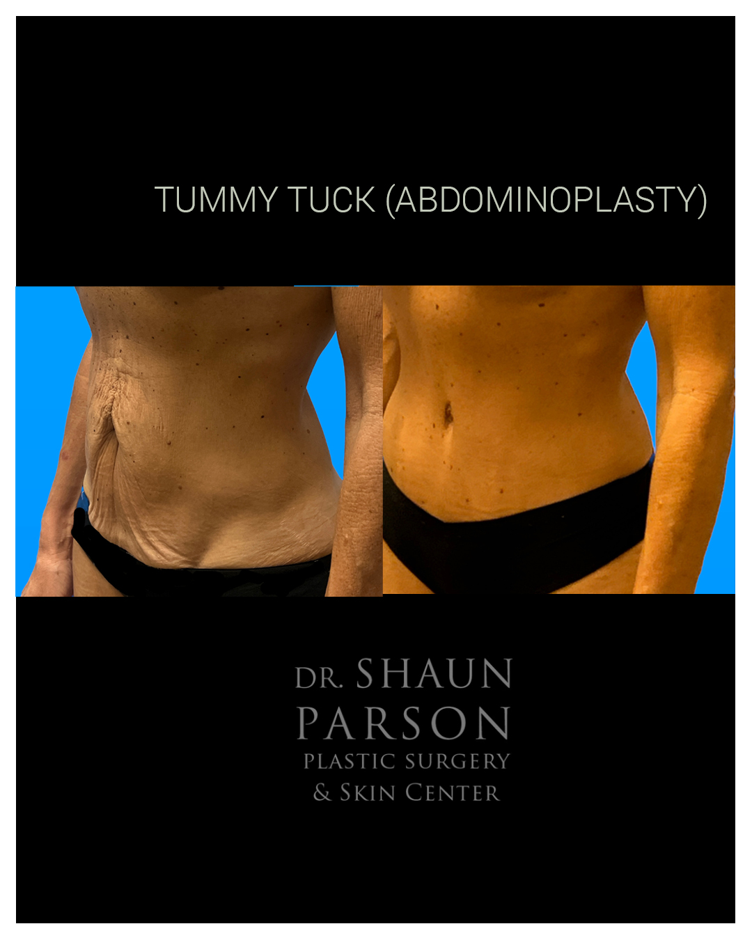 Tummy Tuck Before & After Scottsdale AZ
