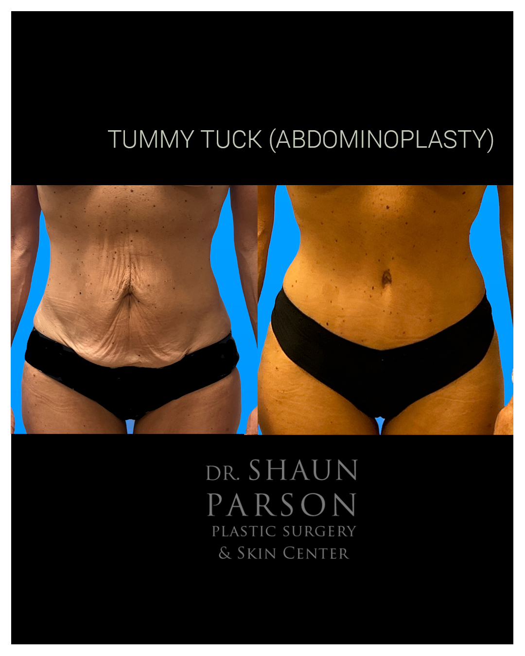 Tummy Tuck Before & After Scottsdale AZ
