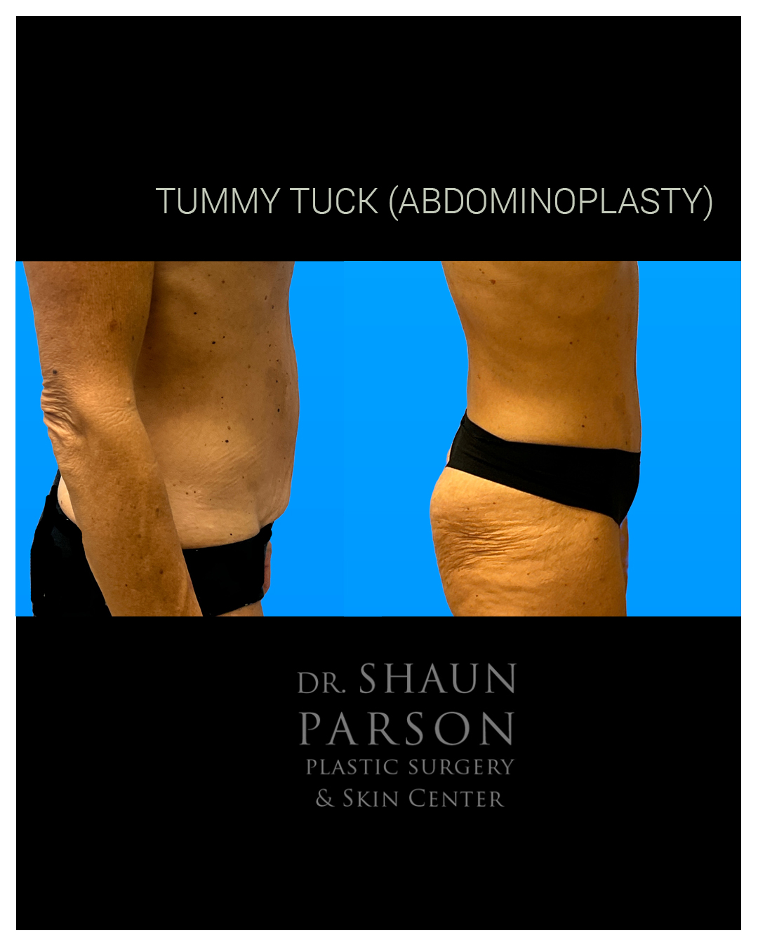 Tummy Tuck Before & After Scottsdale AZ