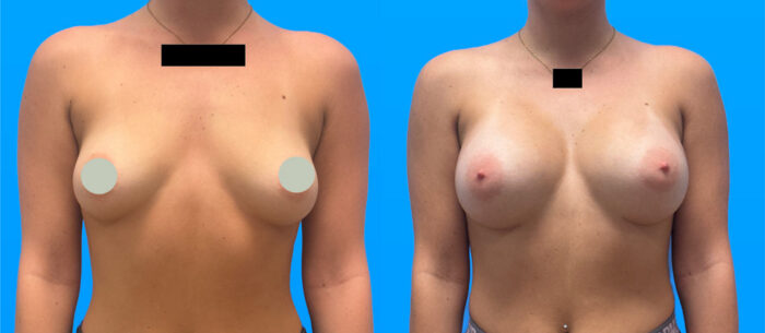 Breast augmentation before and after patient results by Dr. Parson in Scottsdale, AZ.