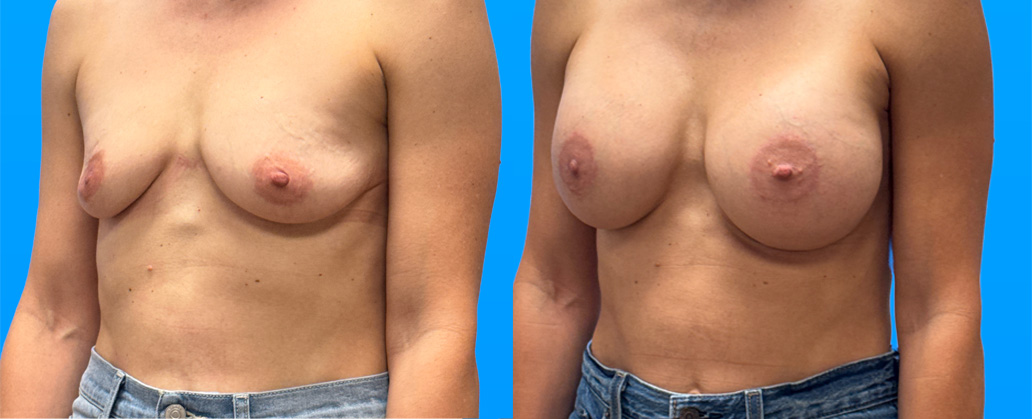 Oblique before and after breast profile 1