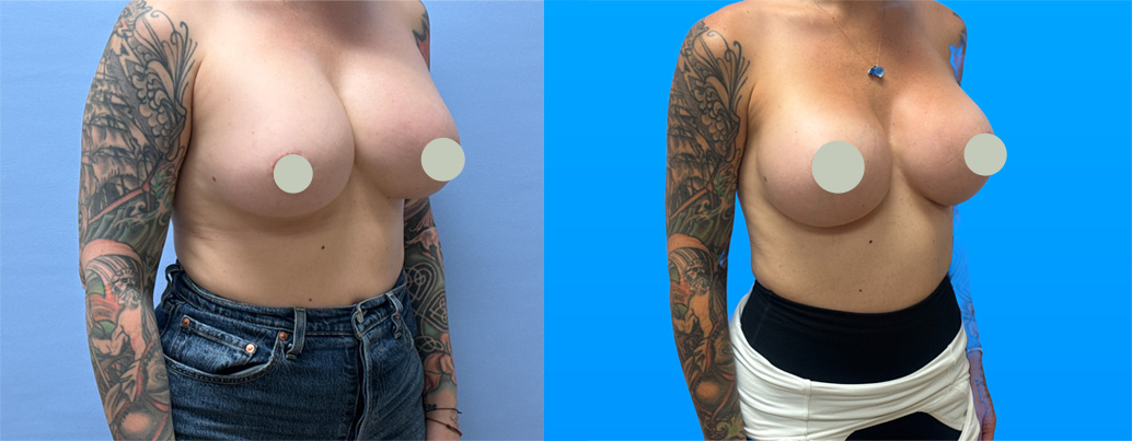 Before-and-after photos of a 37-year-old Scottsdale breast implant exchange patient following implant rupture, using Natrelle SoftTouch SSX 800cc implants