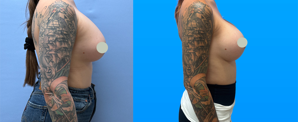 Before-and-after photos of a 37-year-old Scottsdale breast implant exchange patient following implant rupture, using Natrelle SoftTouch SSX 800cc implants