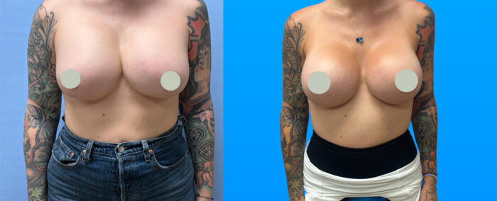 Before-and-after photos of a 37-year-old Scottsdale breast implant exchange patient following implant rupture, using Natrelle SoftTouch SSX 800cc implants