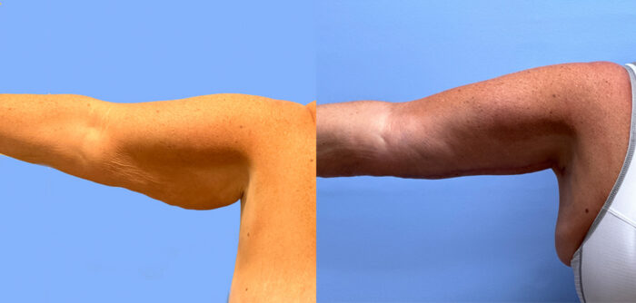 Arm Lift Patient 6 | Scottsdale